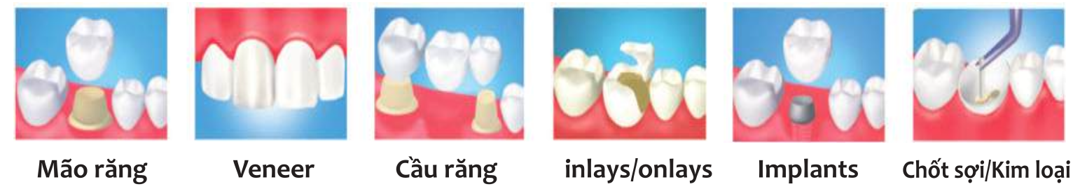 Xi măng gắn🌱Veneer và phục hình PANAVIA V5 PASTE Kuraray giá tốt🌱NHA KHOA MALL🌱